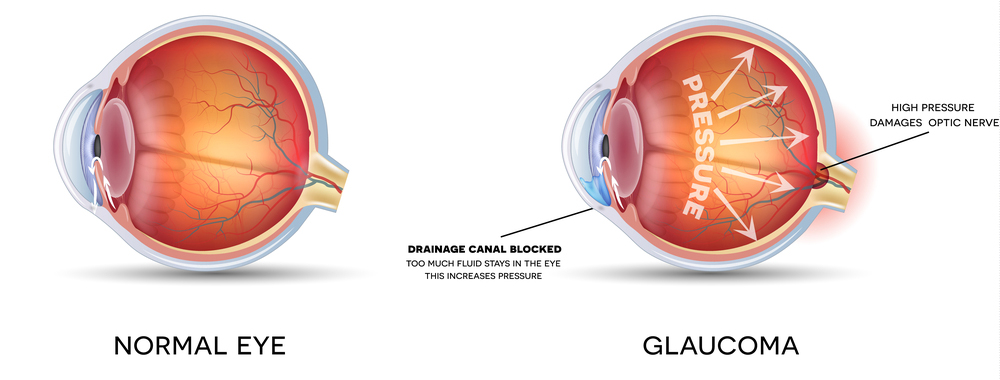 Glaucoma1